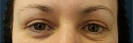 Eyelid1 after