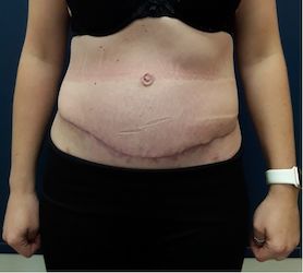 Abdominoplasty2 after