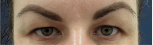 Eyelid2 before