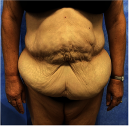 FDL pre-op