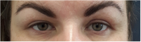Eyelid2 after