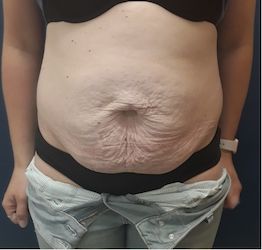 Abdominoplasty2 before