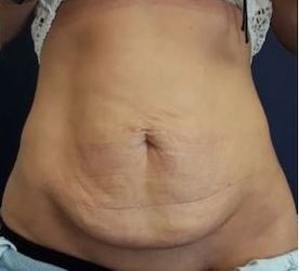 Abdominoplasty1 before