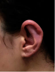 Ear1 after