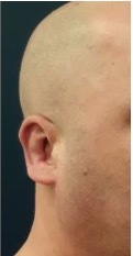 Ear2 after