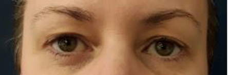 Eyelid1 before