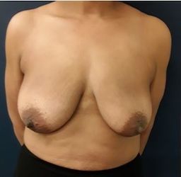 Mastopexy2 before