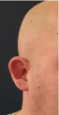 Ear2 before