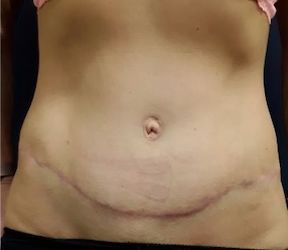 Abdominoplasty1 after